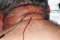 Bhupendra "C" point for cervical spondylosis